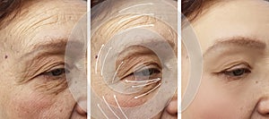 Woman elderly facial wrinkles correction cosmetology regeneration before and after procedures arrow