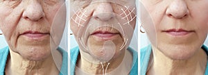 Woman elderly facial wrinkles correction before and after procedures arrow