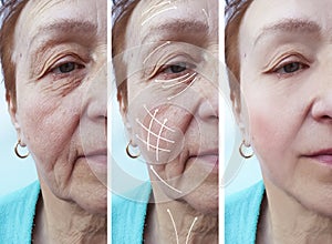 Woman elderly facial wrinkles correction regeneration before and after procedures arrow