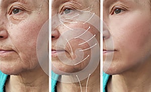 Woman elderly facial wrinkles correction therapy cosmetology regeneration before and after procedures arrow