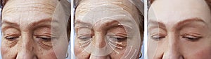 Woman elderly facial wrinkles lifting filler medicine therapy cosmetology regeneration before and after procedures arrow