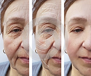 Woman elderly facial wrinkles lifting medicine therapy cosmetology regeneration before and after procedures arrow