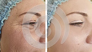 Woman elderlyface wrinkles  correction before after lifting biorevitalization regeneration antiaging treatment