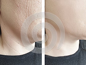 Woman  elderlyface wrinkles before and after lifting biorevitalization regeneration antiaging treatment photo