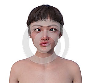 A woman with esotropia, 3D illustration