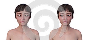 A woman with esotropia and a healthy woman, 3D illustration