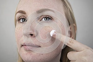 A woman examines dry skin on her face. Peeling, coarsening, discomfort, skin sensitivity. Patient at the appointment of a photo