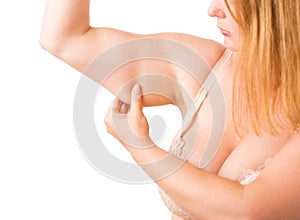 Woman with excess fat on arm