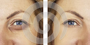 Woman, eye swollen before and after procedures, treatm