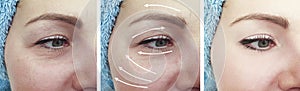 Woman eye wrinkles before age results correction after procedures arrow collage