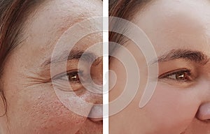 Woman eye wrinkles before and after cosmetic procedures