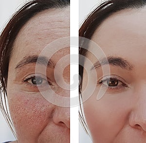 Woman eye wrinkles before and after dermatology cosmetic hydrating procedures