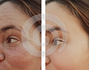 Woman eye wrinkles before and after dermatology cosmetic procedures