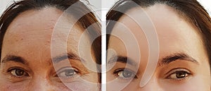 Woman eye wrinkles before and after dermatology effect retouch cosmetic hydrating procedures