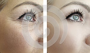 Woman eye wrinkles before and after procedures