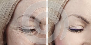 Woman eye wrinkles before and after treatment procedures biorevitalization