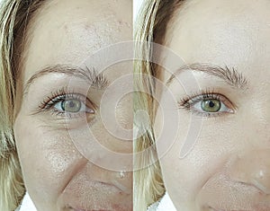 Woman eyes removal wrinkles before and after therapy antiaging difference results revitalization treatment