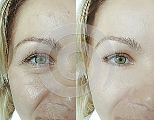 Woman eyes removal wrinkles before and after therapy antiaging difference results revitalization treatment photo