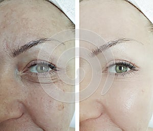 Woman eyes wrinkles puffiness result before and after beautician treatment