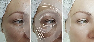 Woman eyes wrinkles before after  regeneration  collage treatment arrow blepharoplasty