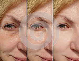 Woman eyes wrinkles antiaging  crease correction contrast revitalization collage treatment before and after treatment effect photo