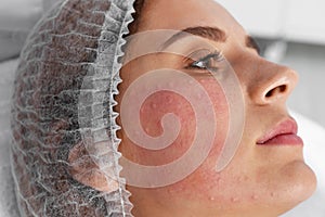 Woman after face biorevitalization procedure in salon, closeup.