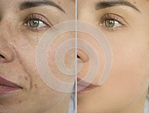 Woman face correction plastic wrinkles before and after treatment difference
