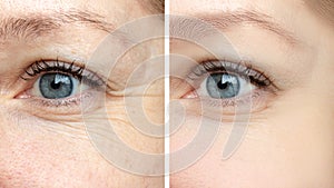 Woman face, eye wrinkles before and after treatment - the result of rejuvenating cosmetological procedures of biorevitalization, photo