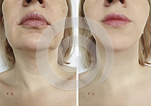 Woman face lift before and after treatment