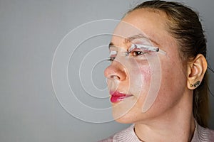 woman face after plastic surgery, blepharoplasty operation, swelling eye bags, incisions with removable stitches