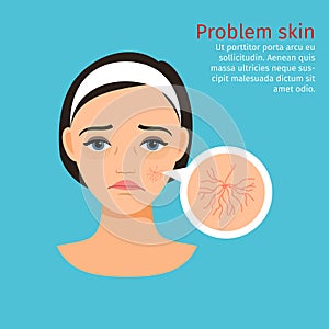 Woman face problem, buried capillaries skin