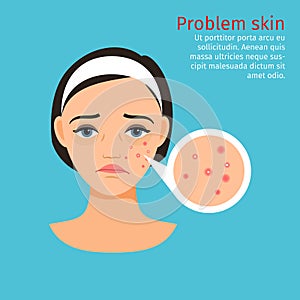 Woman face problem skin with acne