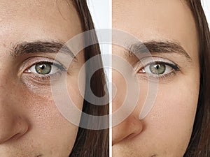Woman face removal correction wrinkles before and after treatment collage