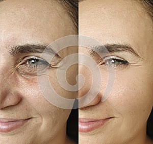Woman skin  face wrinkles facelift correction  rejuvenation  result  therapy before and after treatment collage, puffing photo