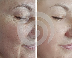 Woman face wrinkles before aging cosmetology difference tension correction removal after treatment arrow