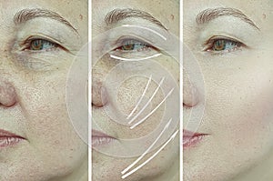 Woman face wrinkles before aging  difference tension correction removal after treatment arrow