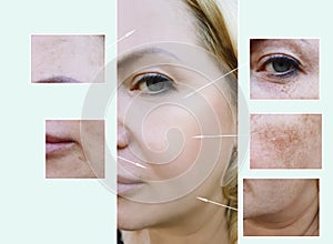 Woman face wrinkles before and after aging procedures, pigmentation dermatology