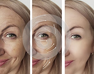 Woman face wrinkles before after arrow mature lifting therapy correction