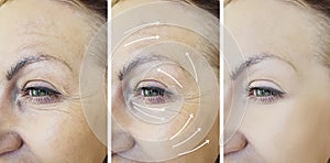 Woman face wrinkles before after arrow mature lifting therapy difference n