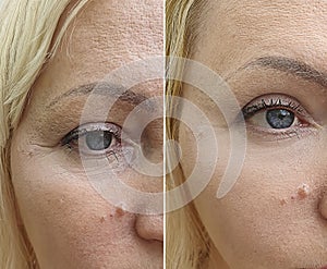 Woman face wrinkles before after beautician difference rejuvenation correction tension