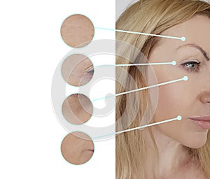 Woman face wrinkles before beautician removal mature regeneration r rejuvenation collage treatment