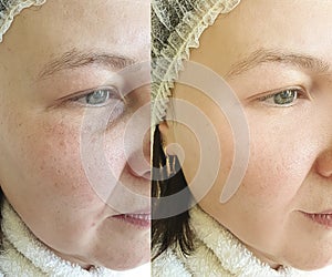 Woman face wrinkles   beautician  removal  before and after treatment collage