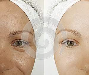 Woman face wrinkles before and after beautician sagging contrast treatment rejuvenation cosmetology