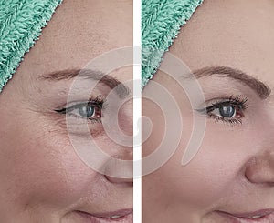 Woman face wrinkles before and after beautician therapy results collage treatments effect