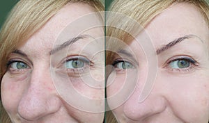 Woman face wrinkles  contrast aging    tightening   before  after treatment sagging