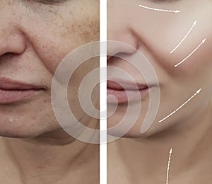 Woman face wrinkles before and after contrast patient rejuvenation therapy difference procedures, arrow