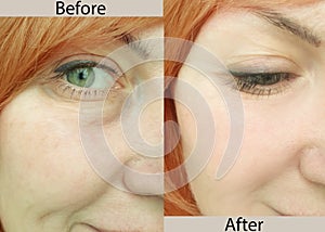 Woman face wrinkles contrast    before and after treatment aging