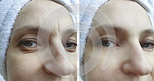 Woman face wrinkles before and after correction
