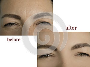 Woman face wrinkles correction concept difference before and after treatment