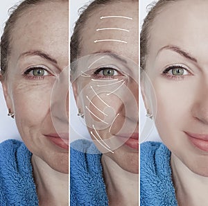 woman face wrinkles correction dermatology beautician removal before and after procedures, arrow